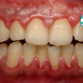 بیماری های ژنژیویت و پریودونتیت که لثه ها را درگیر می کنند چه علائمی دارند؟
