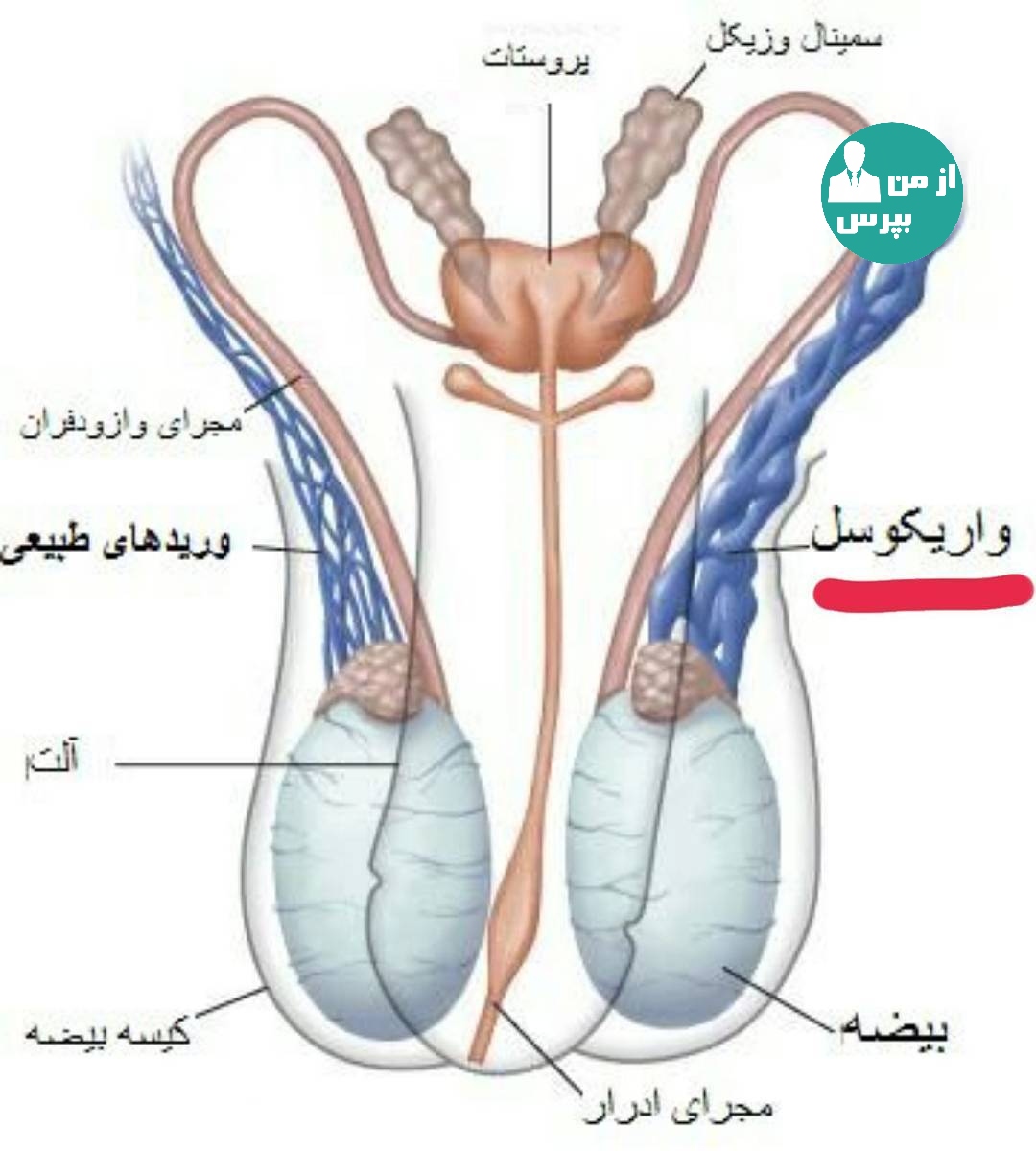 Расширение вены семенного канатика. Варикоцеле – расширение вен семенного канатика. Утолщение семенного канатика. Расширение семенного канала. Эмболизация варикоцеле.