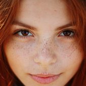 شناخت برخی از لک های پوستی خانم ها